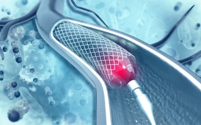Đã đặt 4 stent có nên dùng thêm sản phẩm thảo dược hỗ trợ không?
