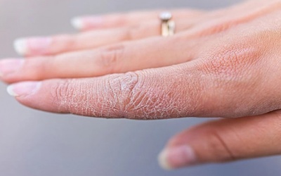 Thói quen đơn giản giúp ngừa khô tay