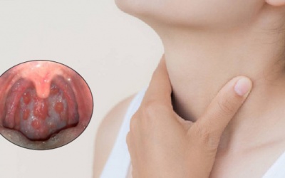 Dấu hiệu nhận biết sớm viêm họng hạt bạn nên biết