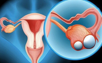 Nhận biết sớm dấu hiệu u nang nước buồng trứng
