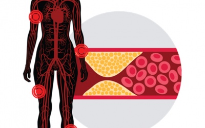 Đái tháo đường: Biến chứng mạch máu nhỏ làm tăng nguy cơ mù lòa, suy thận