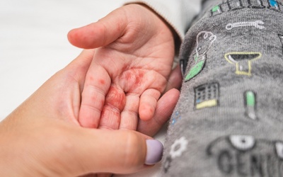 Sai lầm cần tránh khi chăm trẻ mắc bệnh tay chân miệng