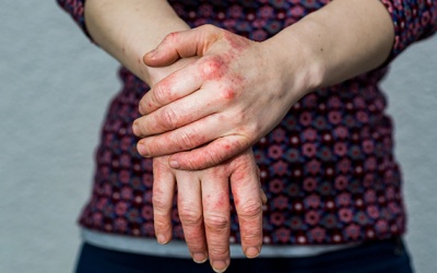 Biện pháp giảm cứng khớp do viêm khớp vảy nến