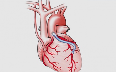 Hẹp mạch vành: Bắc cầu mạch vành có nguy hiểm không?