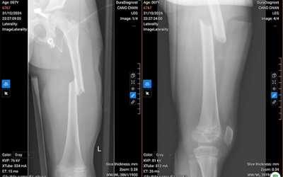 BV Nhi Hà Nội: Phẫu thuật gãy xương đùi bằng phương pháp xâm lấn tối thiểu