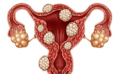 Triệu chứng và cách cải thiện bệnh đa nhân xơ tử cung 