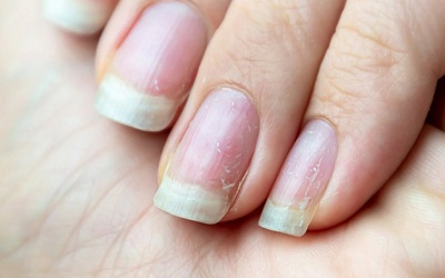 5 thói quen khiến móng tay yếu và dễ gãy 