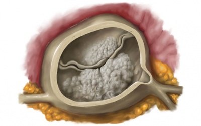 Người bệnh hở van tim làm sao ngừa vôi hóa van tim?