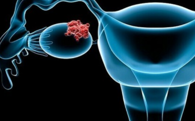 Những triệu chứng này có thể là của ung thư buồng trứng