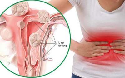 5 cách phòng ngừa nhân xơ tử cung