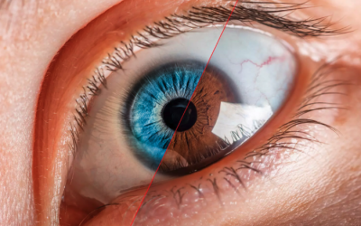 Phẫu thuật thay đổi màu mắt và những rủi ro có thể gặp phải