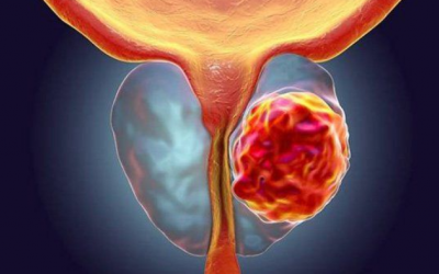 Bảo vệ sức khoẻ tuyến tiền liệt: Nên và không nên ăn gì?