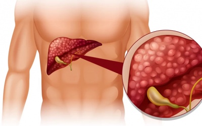 Sỏi túi mật 4,6mm nên điều trị thế nào?