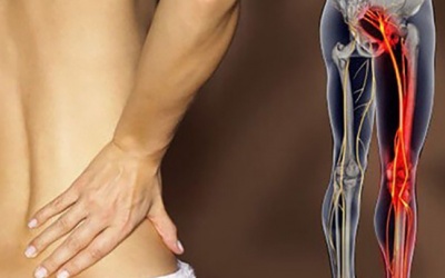 Dấu hiệu nhận biết đau thần kinh tọa và giải pháp cải thiện tại nhà