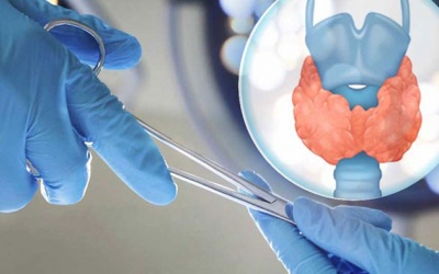Những điều cần biết về phẫu thuật bướu nhân tuyến giáp