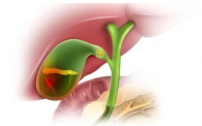 Dấu hiệu, triệu chứng cảnh báo viêm túi mật