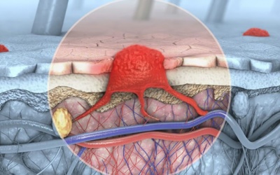 Hàng trăm triệu người trên thế giới sống chung với herpes sinh dục