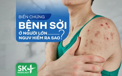 Podcast: Biến chứng bệnh sởi ở người lớn nguy hiểm ra sao?