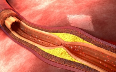 Tác hại của xơ vữa động mạch và cách phòng ngừa từ thảo dược tự nhiên