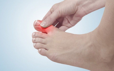 Bệnh u xương ngón chân cái và lời khuyên từ chuyên gia 