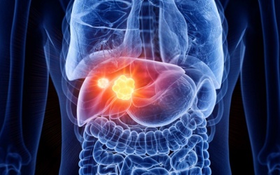 Điểm mặt 3 “thủ phạm chính” gây ung thư gan