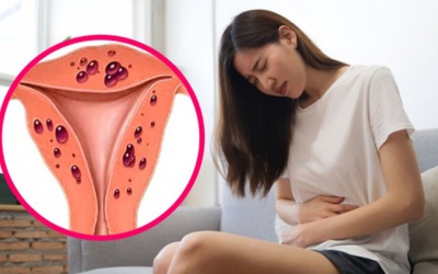 Nhiều phụ nữ phải nghỉ học, nghỉ làm vì cơn đau lạc nội mạc tử cung