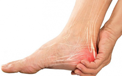 Nguyên nhân, triệu chứng và cách điều trị bệnh Viêm gân gót chân Achilles