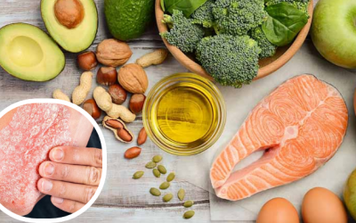 Chế độ ăn cho người bệnh vẩy nến