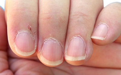 Biện pháp chăm sóc bàn tay bị xước măng rô