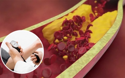 Hẹp mạch vành 30% kèm tăng huyết áp có nguy hiểm không?