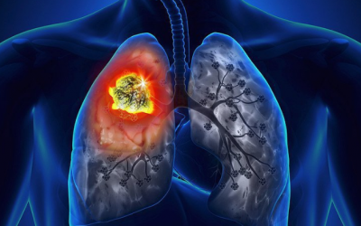 Tại sao ung thư lại thường di căn đến phổi?