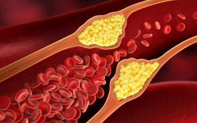 Bệnh máu nhiễm mỡ có thể gây nên các biến chứng nguy hiểm!