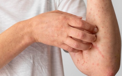 Bệnh viêm da cơ địa có lây không?