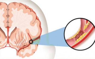 Nhận biết sớm dấu hiệu nhồi máu não