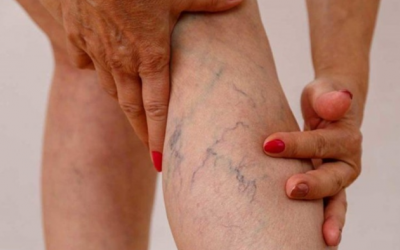 Liệu có thể phòng ngừa bệnh giãn tĩnh mạch?