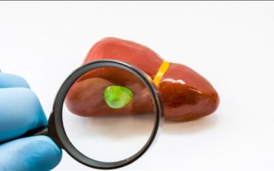 Polyp túi mật có nguy hiểm không, có nguy cơ ung thư không?