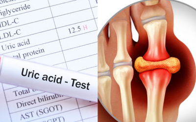 Dấu hiệu acid uric tăng cao và biện pháp kiểm soát