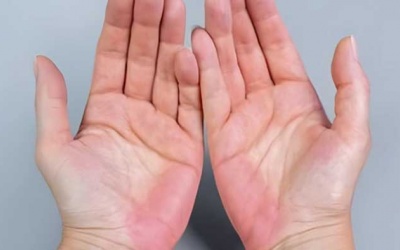 3 dấu hiệu trên tay cảnh báo gan có vấn đề