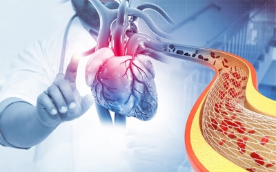 Bệnh mạch vành: Đặt stent sau bao lâu mới ổn định?