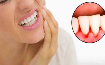 Viêm lợi có nguy hiểm không?