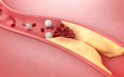 Có những nguyên nhân nào gây thiếu máu cơ tim cục bộ?