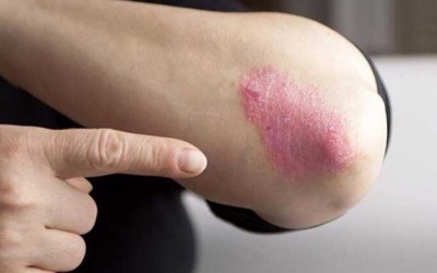 Bệnh vảy nến có trị được không? 