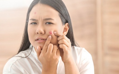 Bí quyết “đánh bay” mụn trứng cá hiệu quả nhanh