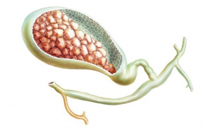 Sỏi mật 32mm có nên phẫu thuật không?