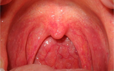 Đốt viêm họng hạt cần lưu ý gì để nhanh hồi phục