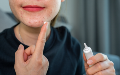 Vì sao sản phẩm trị mụn Profiderm Azelaic Gel bị thu hồi?