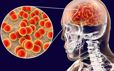 Viêm màng não mô cầu: Bệnh hô hấp nguy hiểm, dễ bị nhầm lẫn 