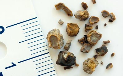 Sỏi túi mật 25mm kèm đái tháo đường nên điều trị thế nào?