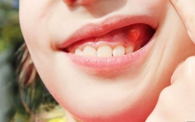 “Thủ phạm” gây viêm lợi có mủ