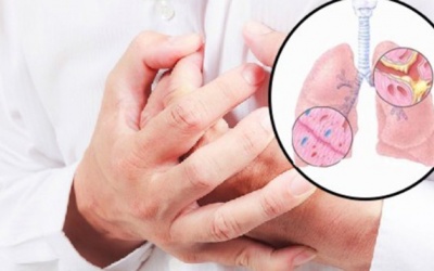 Viêm phế quản mạn tính: Dấu hiệu và những biến chứng nguy hiểm